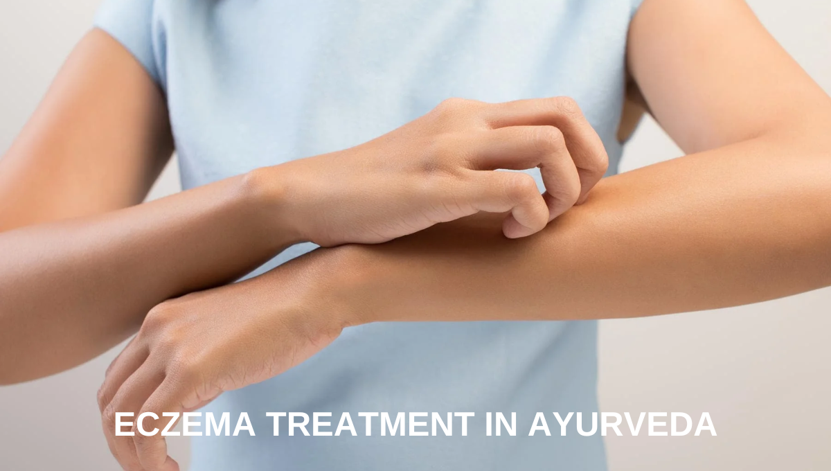 Eczema Treatment in Ayurveda