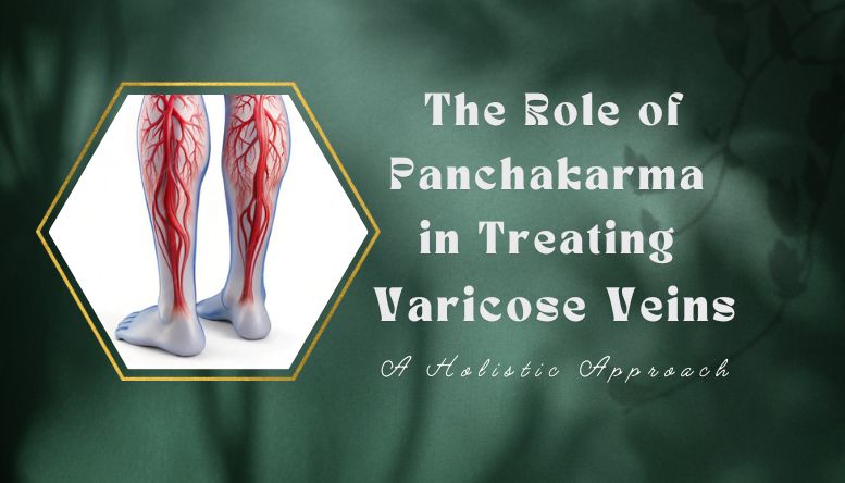 The Role of Panchakarma in Treating Varicose Veins: A Holistic Approach